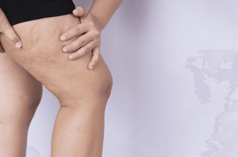 Lipedema: cuando la grasa duele y limita la vida